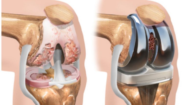 Revolutionizing Mobility: Understanding Total Knee Arthroplasty